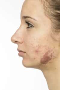 medical acne problems