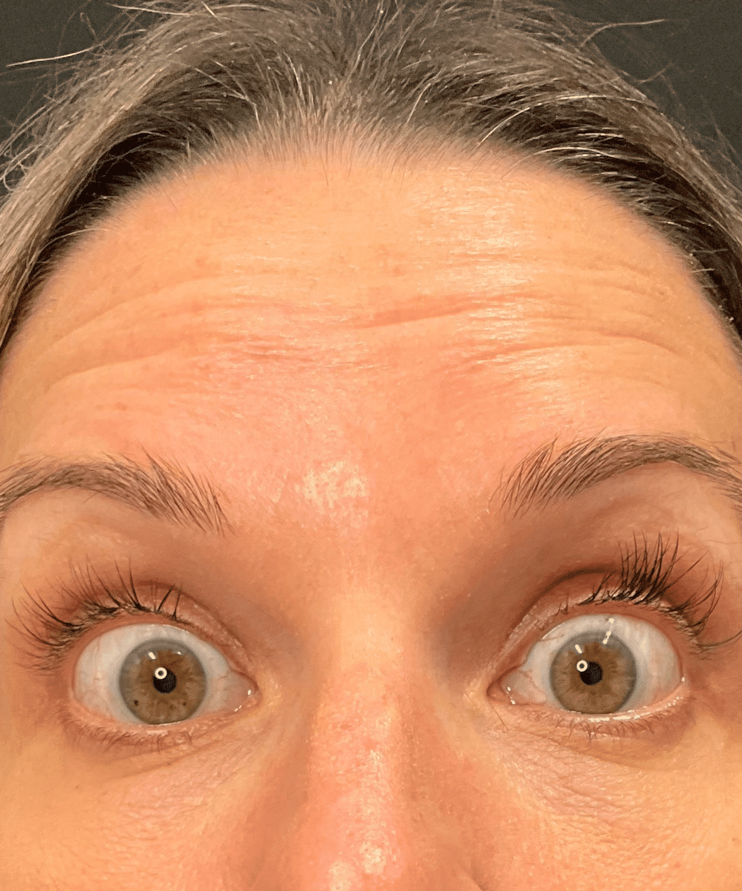 Before Botox Cosmetic in Hauppauge, NY