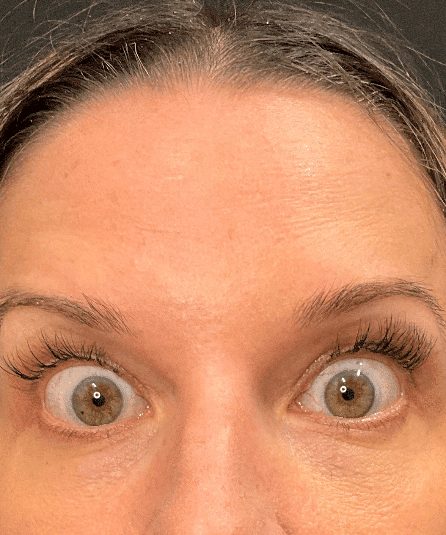 After Botox Cosmetic in Hauppauge, NY