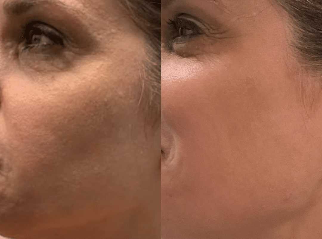 Epstein SkinVive Results Epstein SkinVive Results Hauppauge, NY