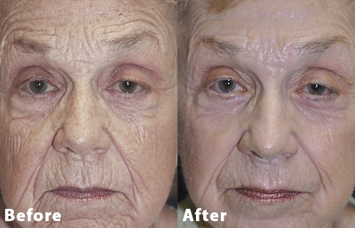 contour trl before after 2