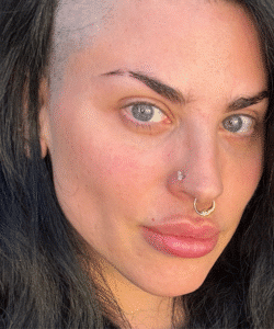 Before Image: Masseter Botox