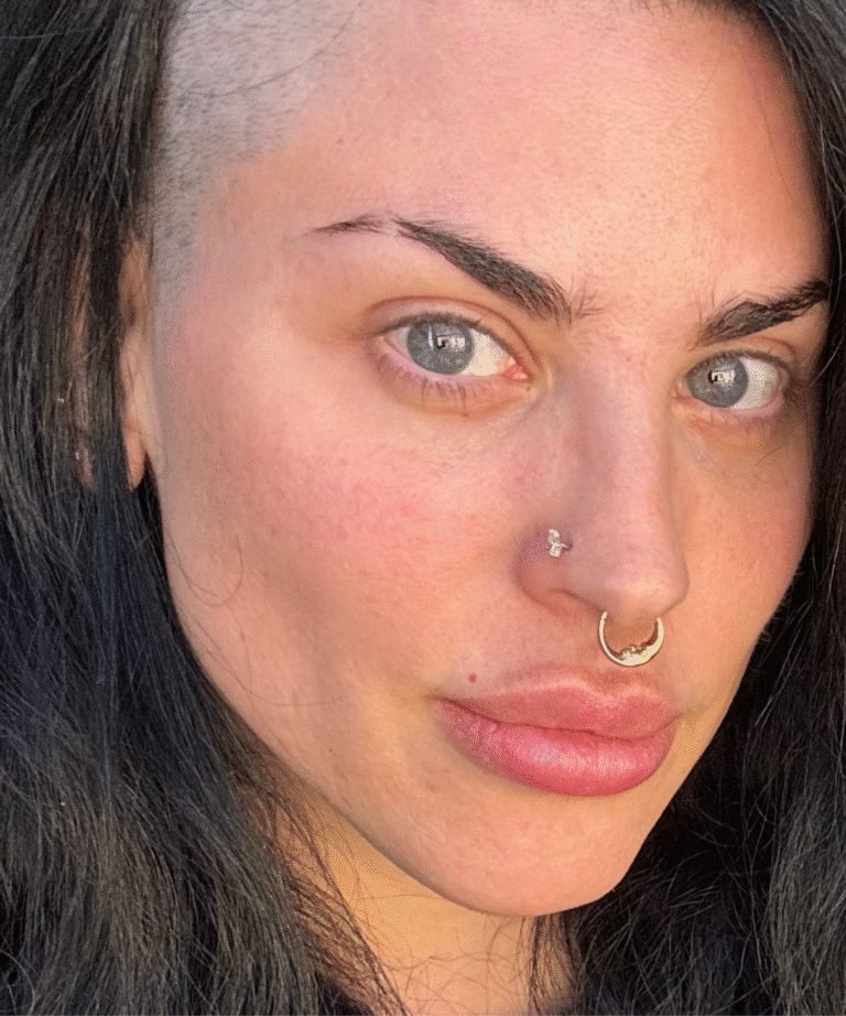 Before Image: Masseter Botox - front