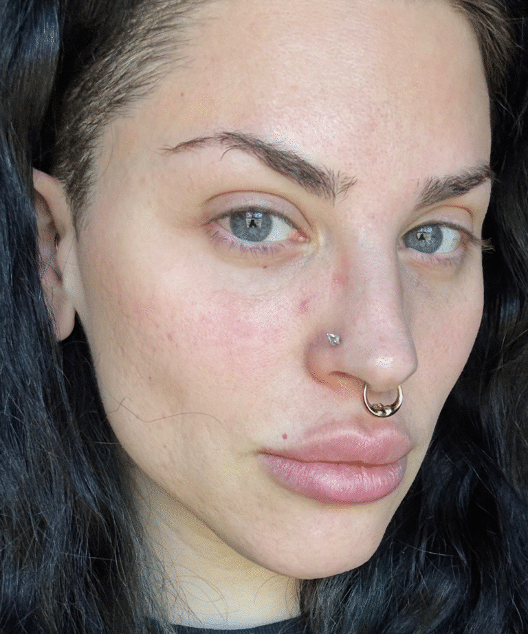 After Image: Masseter Botox - front